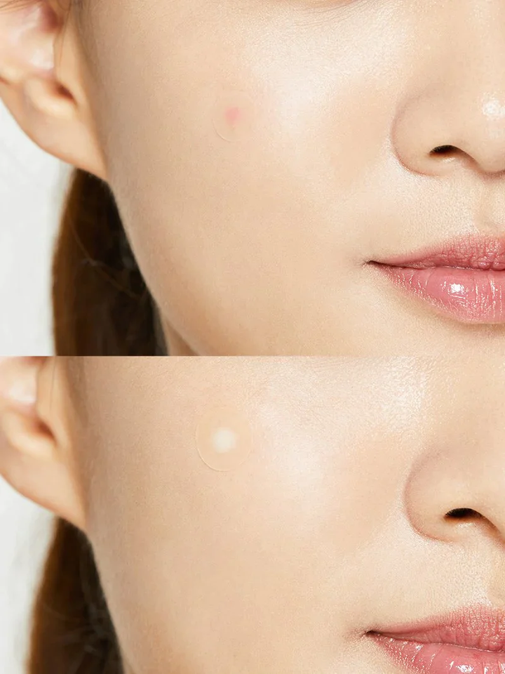 Acne pimple master patch Cosrx 24 piezas